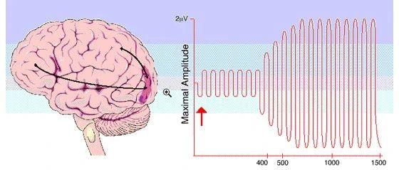 科普｜脑机接口设备植入人体大脑前景如何