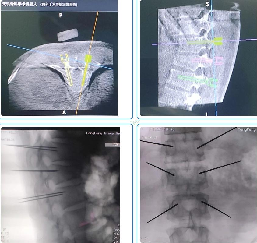 骨科机器人手术“精准到毫米”